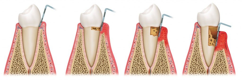 Parodontologie, Parodontose & Parodontitis Behandlung | Zahnarzt
